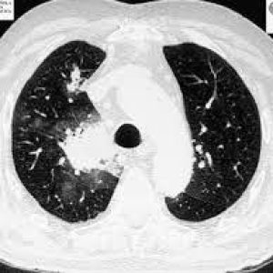 Cirugia-para-aspergiloma-pulmonar.jpg